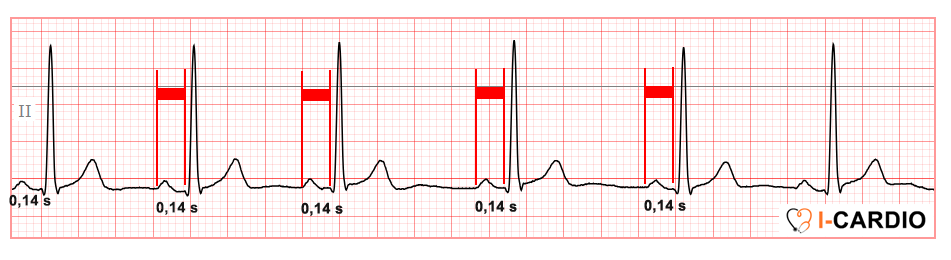 Fragmen of ECG example demonstrating sinus rhythm