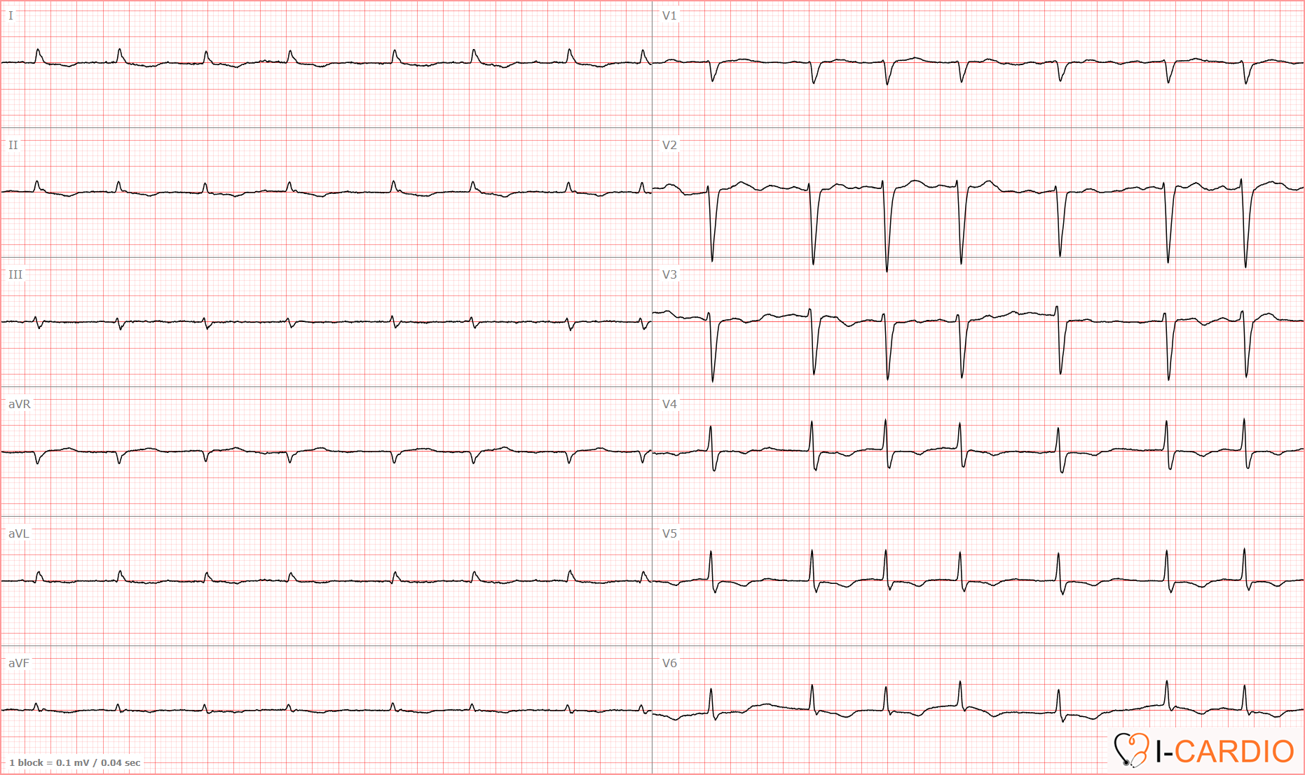 ECG Example 3 – Atrial Fibrillation