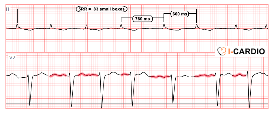 ECG Example 3 – Atrial Fibrillation