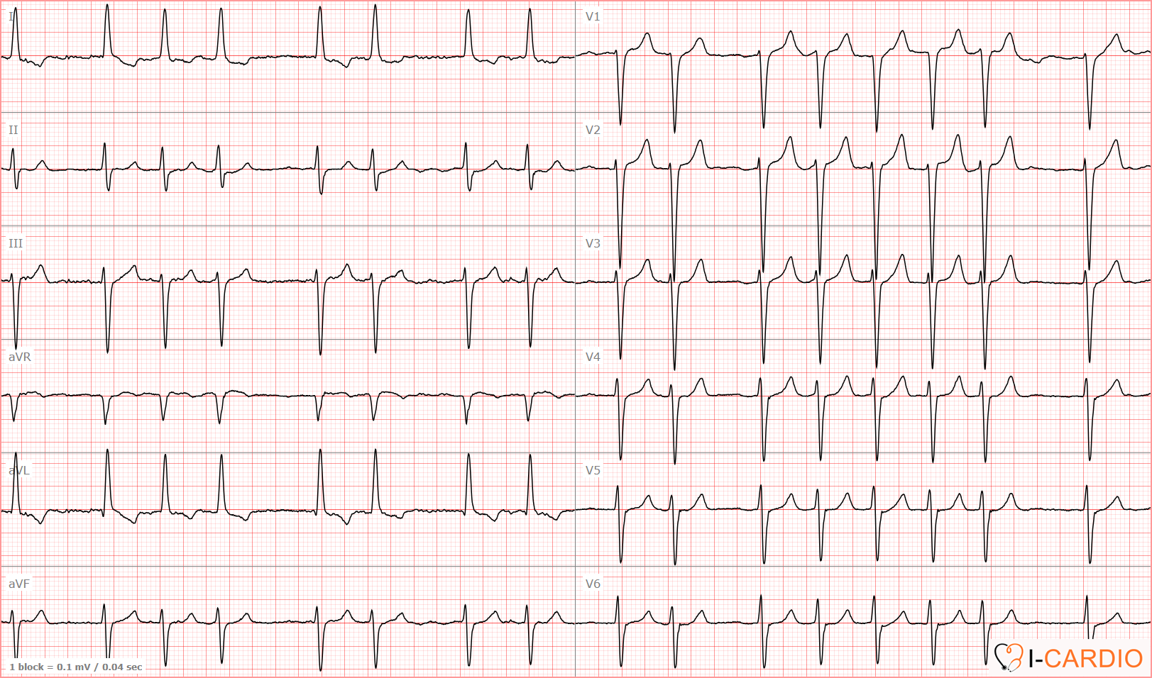 ECG Example 1 – Atrial Fibrillation