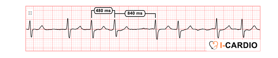 Electrocardiogram Demonstrating Atrial Fibrillation