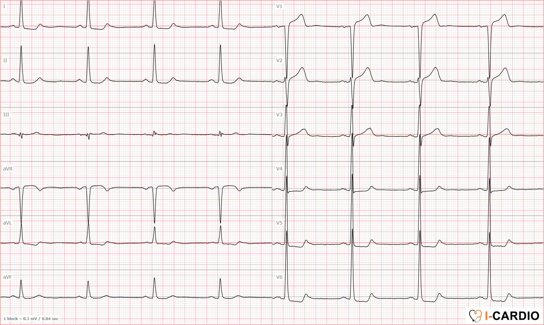 ECG examples of sinus bradycardia