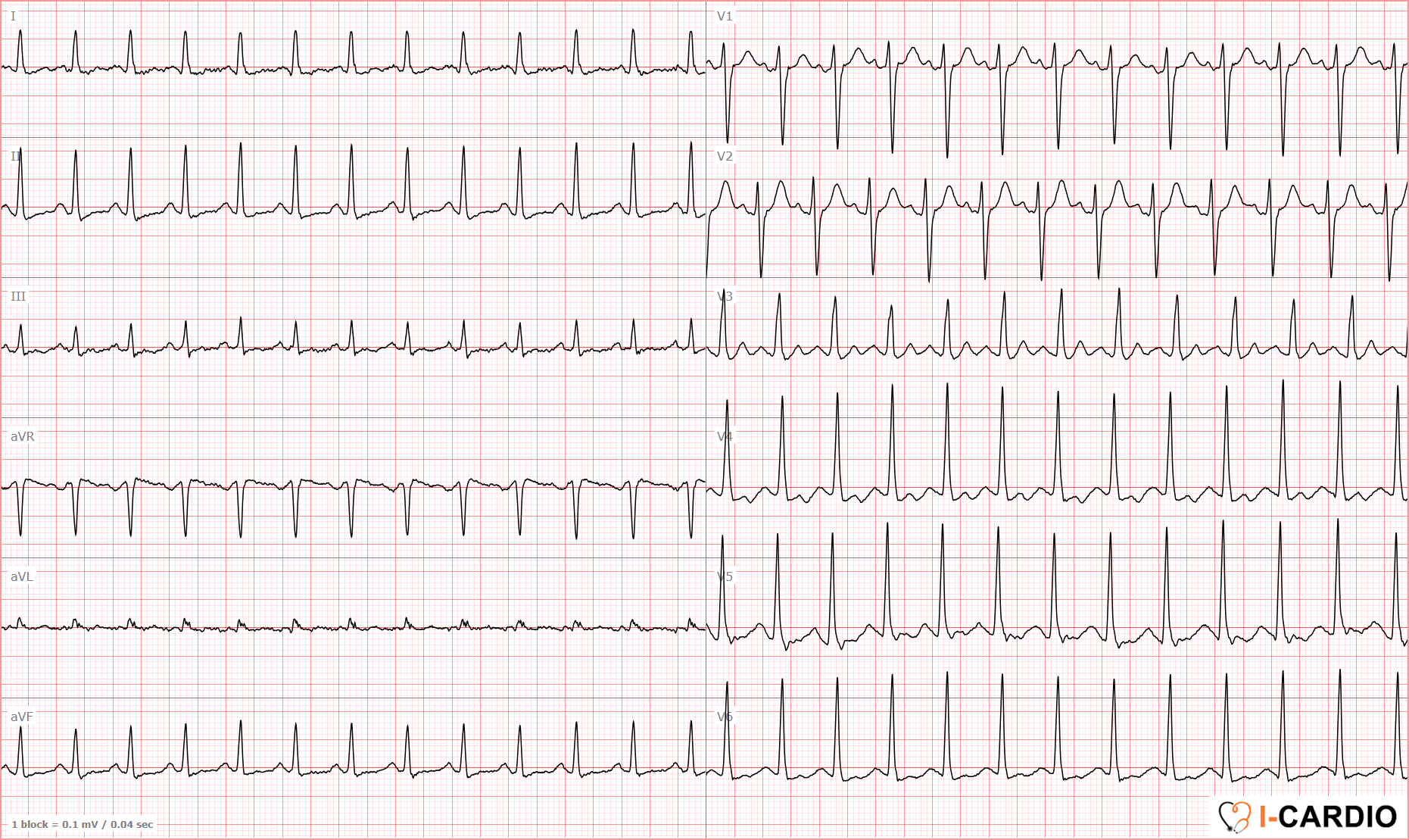 ECG examples of sinus tachycardia